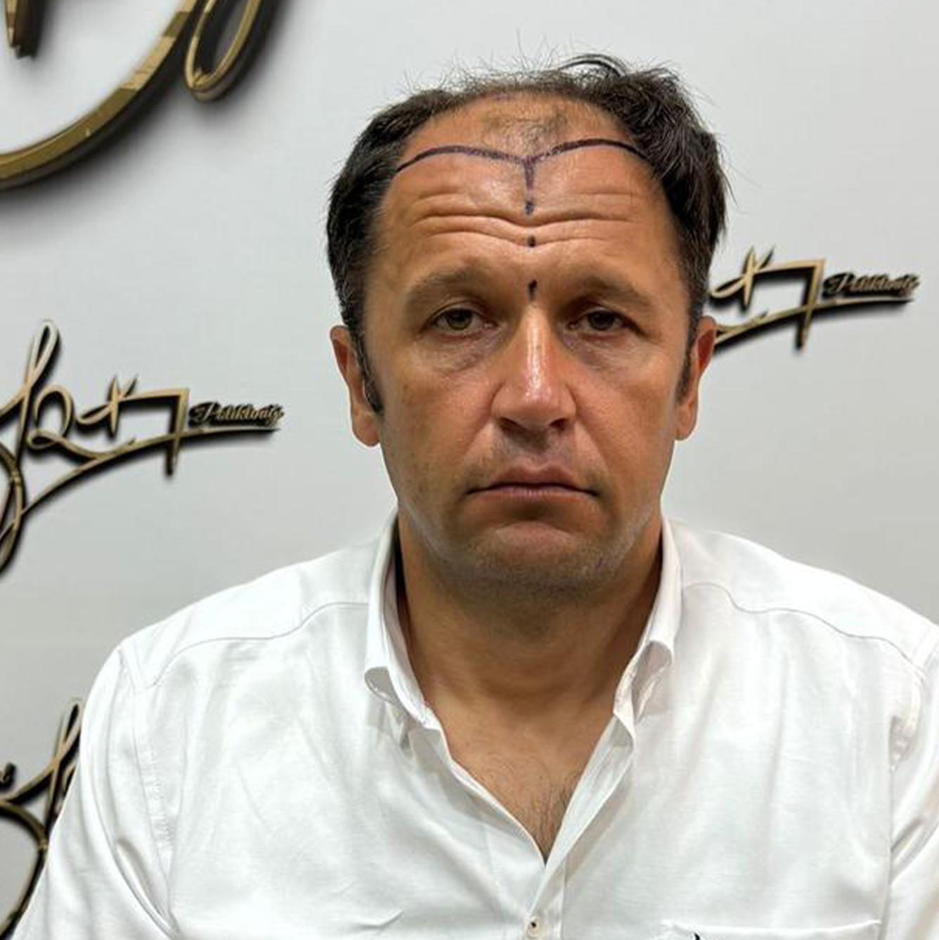 Man with lines drawn on head