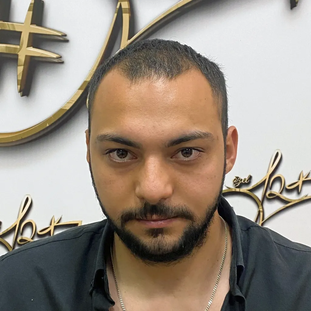 Before Hair Transplant