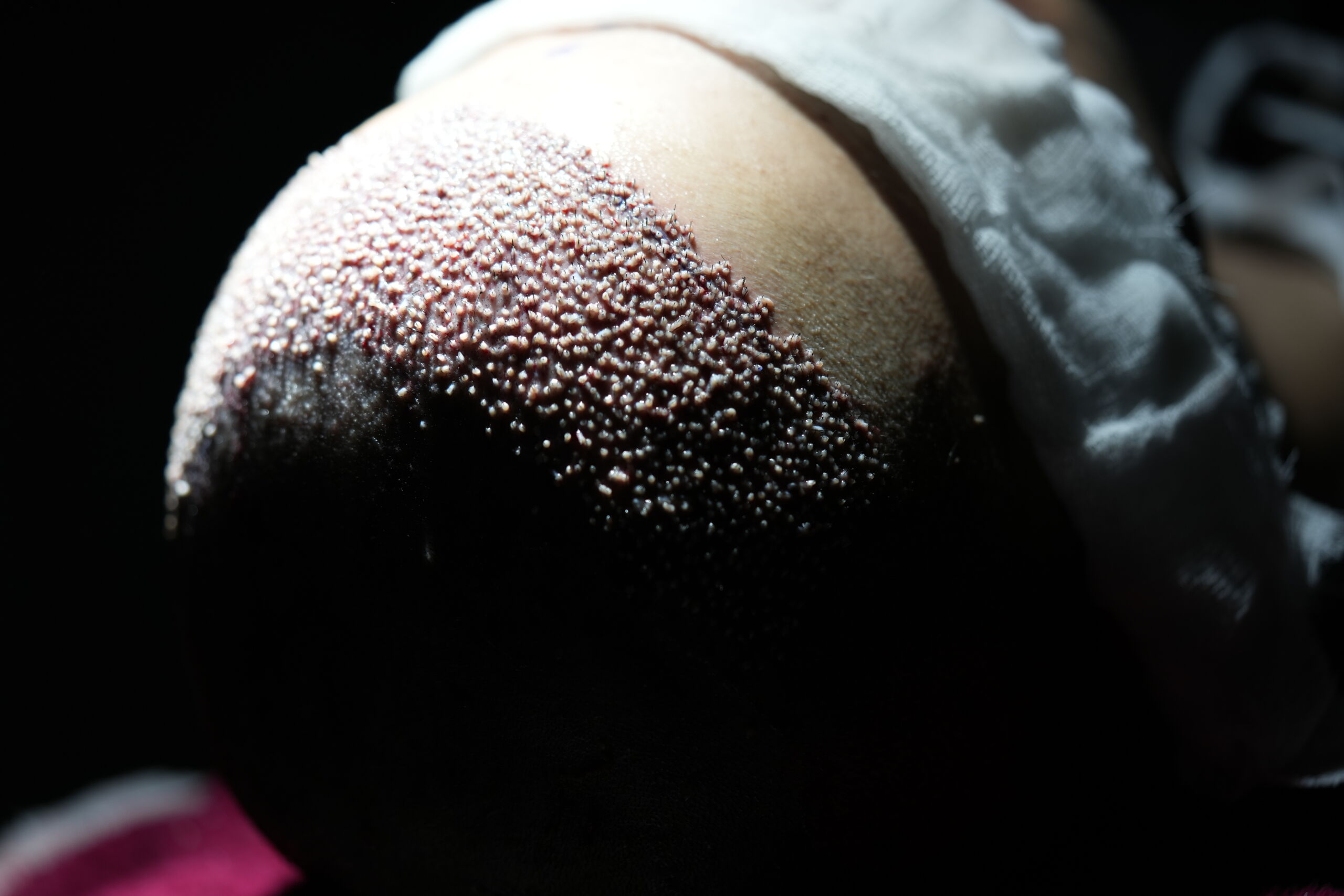 Hair transplant close up