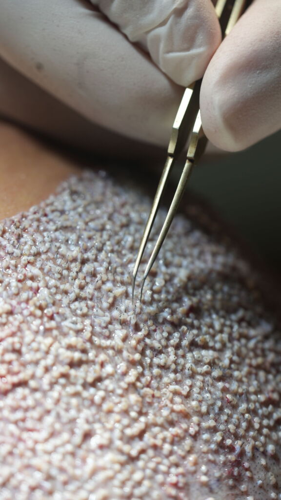 Tweezers being used during hair transplant surgery