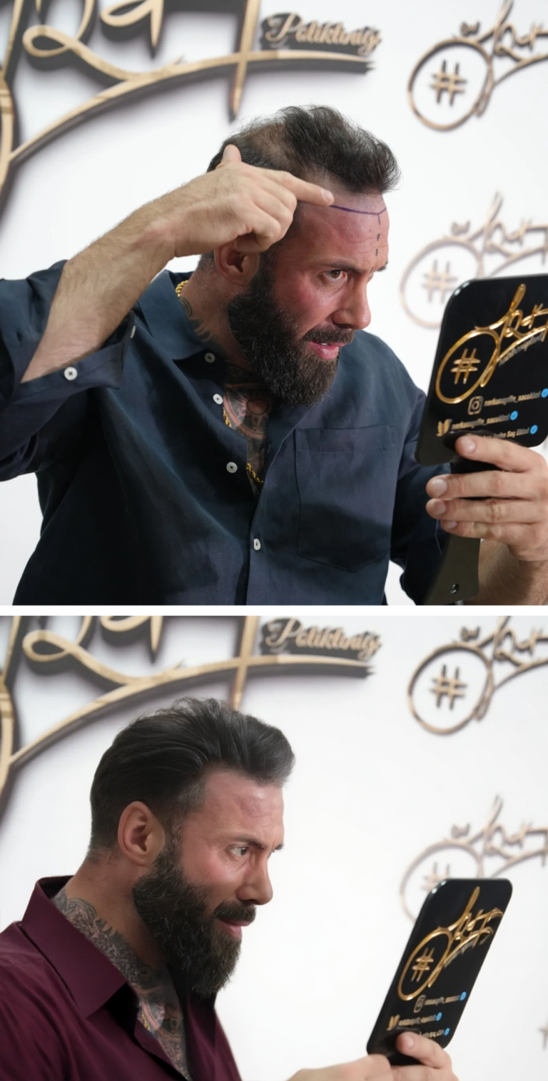 Hair transplant before and after